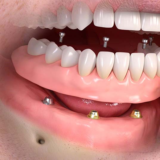 Cura dei denti con protesi fisse - Centro Odontoiatrico Atena (Villa Castelli, Brindisi)